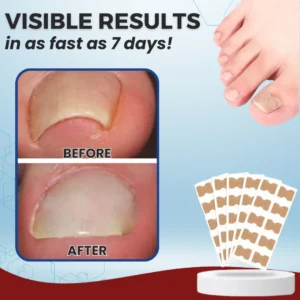 🌟 Official Store | AEXZR® Paronychia Correcting Patch | 50% LIMITED DISCOUNT OFFER✨