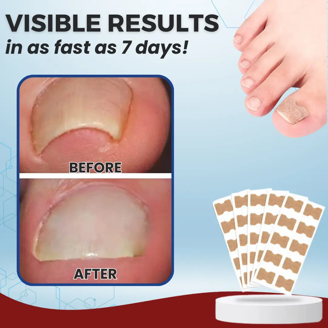 🌟 Official Store | AEXZR® Paronychia Correcting Patch | 50% LIMITED DISCOUNT OFFER✨