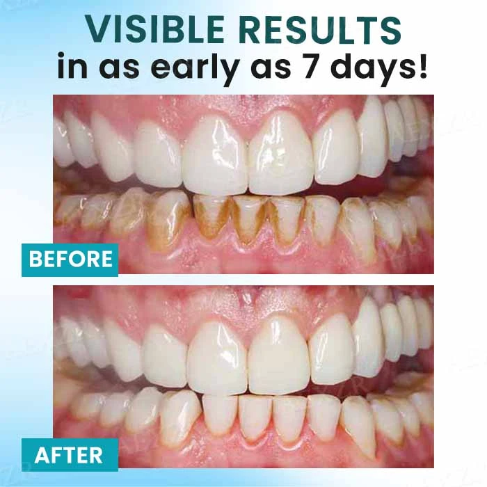 AEXZR® Oral Calculus Suppressant✨𝗙𝗶𝗴𝗵𝘁 𝗧𝗮𝗿𝘁𝗮𝗿 𝗘𝗳𝗳𝗲𝗰𝘁𝗶𝘃𝗲𝗹𝘆!✨