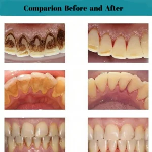 AEXZR® Oral Calculus Suppressant✨𝗙𝗶𝗴𝗵𝘁 𝗧𝗮𝗿𝘁𝗮𝗿 𝗘𝗳𝗳𝗲𝗰𝘁𝗶𝘃𝗲𝗹𝘆!✨