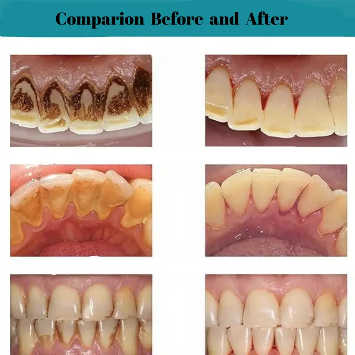 AEXZR® Oral Calculus Suppressant✨𝗙𝗶𝗴𝗵𝘁 𝗧𝗮𝗿𝘁𝗮𝗿 𝗘𝗳𝗳𝗲𝗰𝘁𝗶𝘃𝗲𝗹𝘆!✨