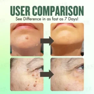 AEXZR® WartsOff Instant Blemish Removal Cream