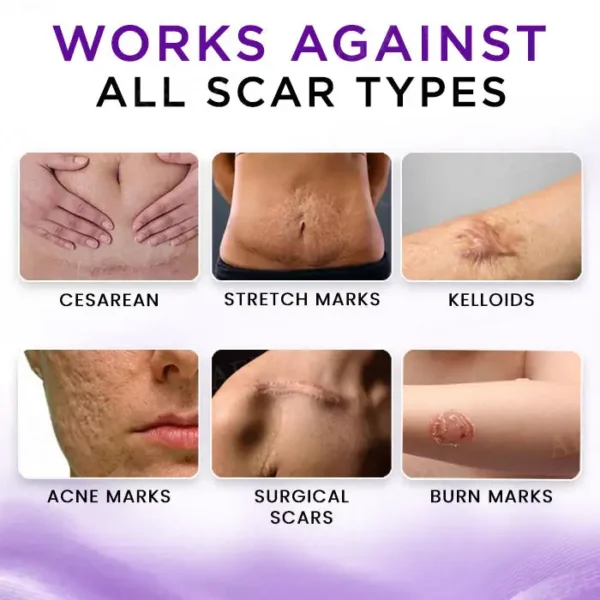 🔥FDA Approved⭐ WHO Approved🌍 AEXZR® Cure Face & Body Scar Gel – Clinically proven to soften, flatten and fade surgical scars, acne marks, burns, keloids and trauma-related scars.