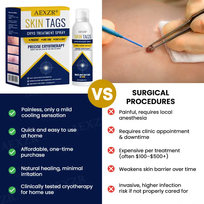 🔥18 Pcs Left !!!- Warts No More - 50% OFF | AEXZR® Skin Tag Cryo Treatment Spray