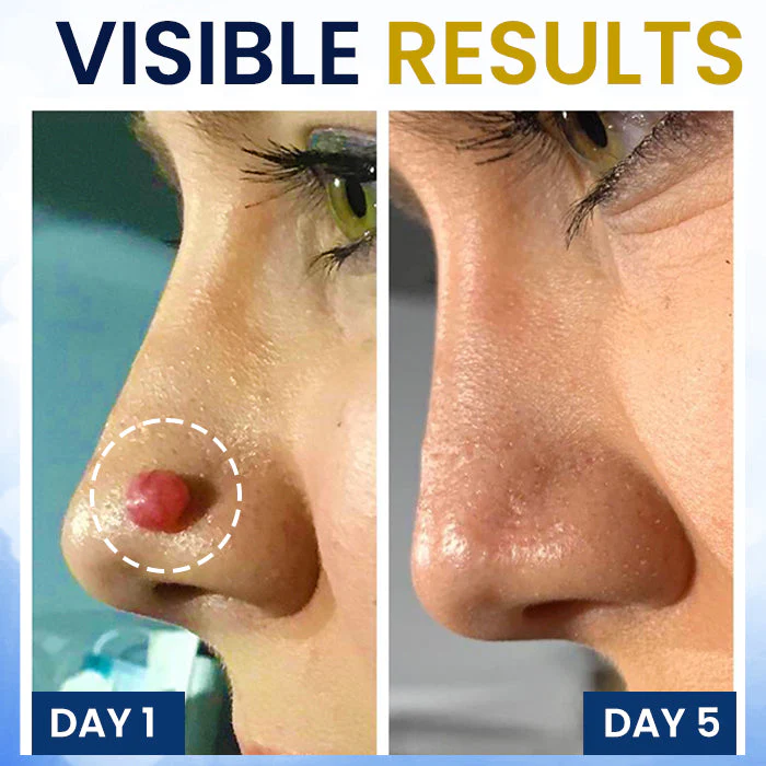 AEXZR® Skin Tag Cryo Treatment Spray - Image 3