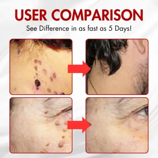 AEXZR® Nano-Microdart Skin Tag & Spot Corrector Patches