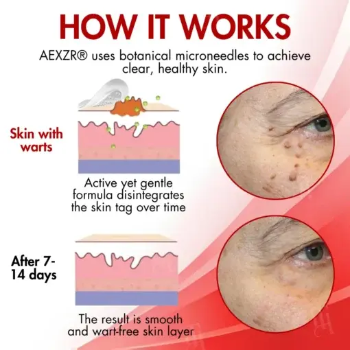 AEXZR® Nano-Microdart Skin Tag & Spot Corrector Patches